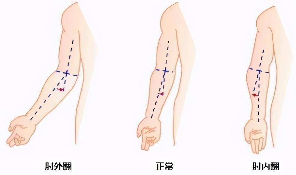 肘内翻最新矫正技术，探索与创新之道